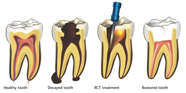  Root Canal Treatment