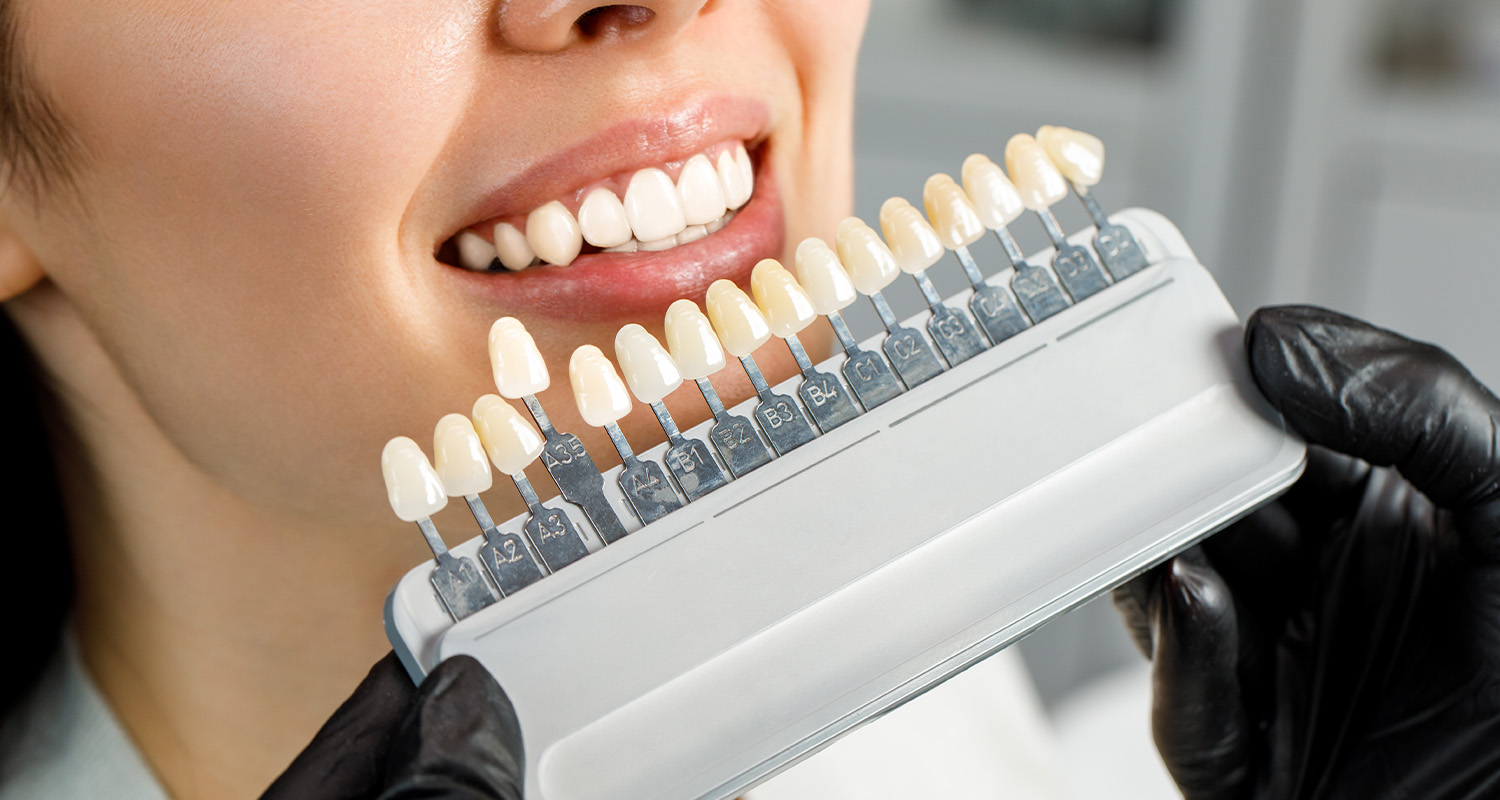 Are Veneers Right for You? Who Should and Shouldn’t Get Them
