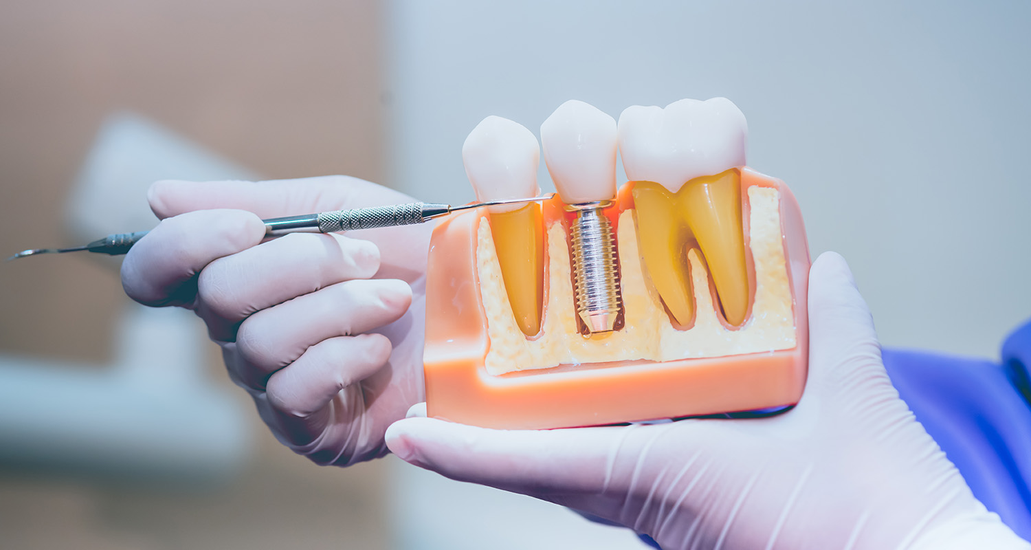 Do Dental Implants Last a Lifetime? What You Should Know