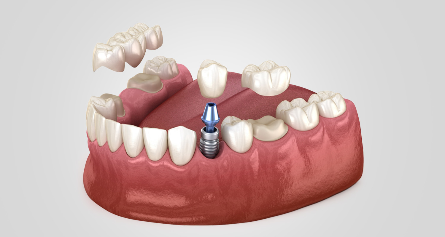 Dental Implants vs. Bridges – Which Is Better for Missing Teeth?