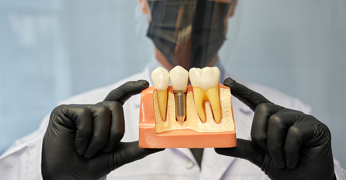 Myths About Dental Implants