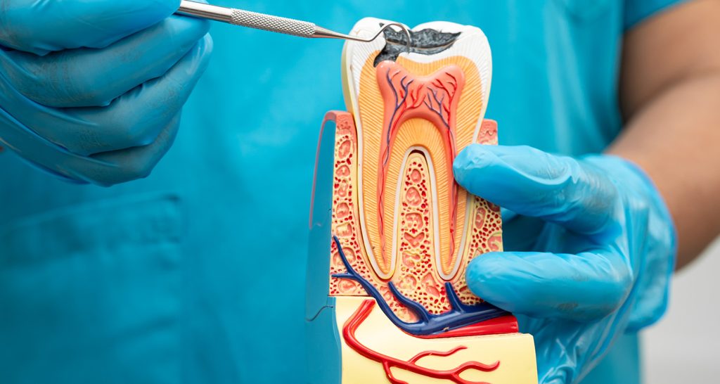What Happens if You Skip a Root Canal 